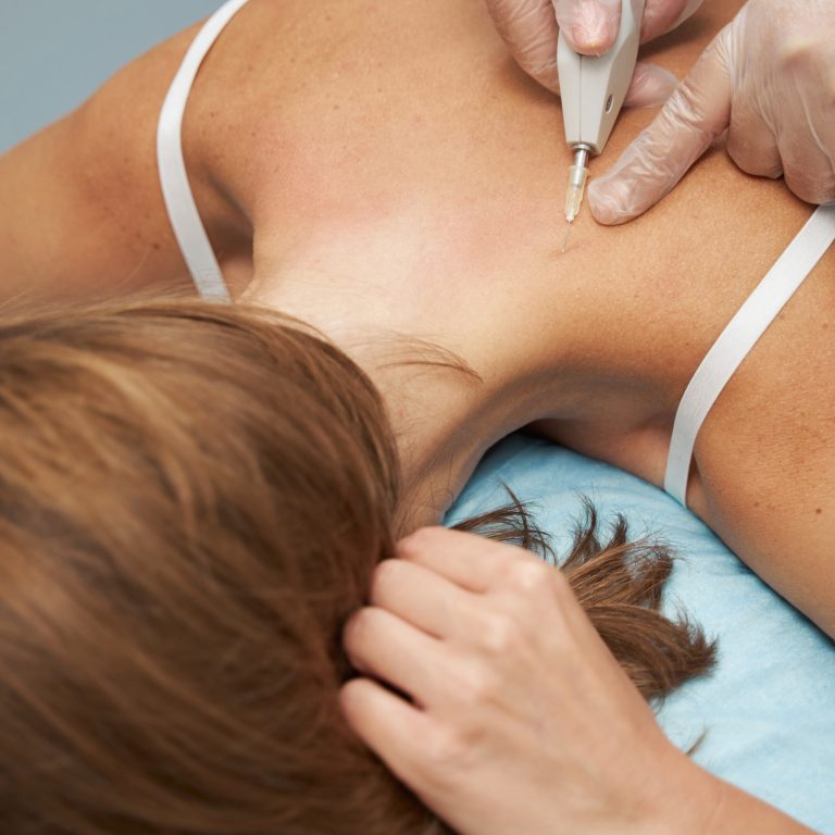 Carboxytherapy_4